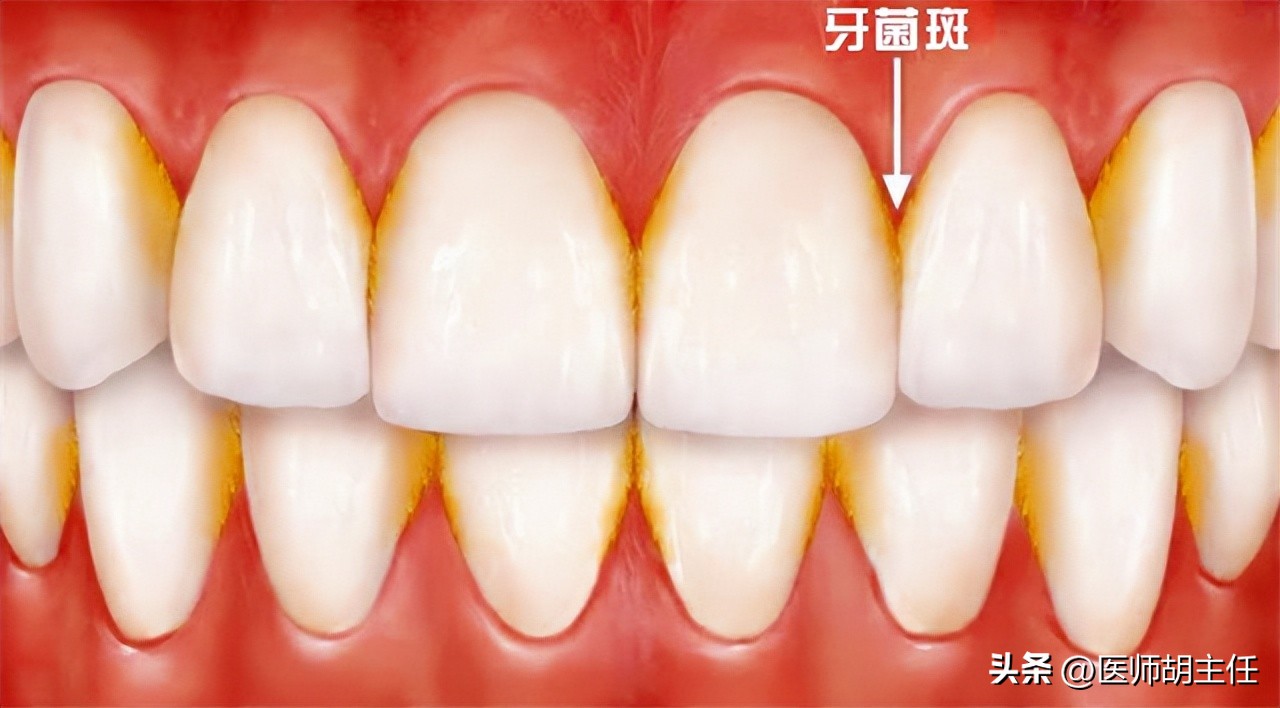 在牙缝里的牙结石要怎么去除,牙缝的牙结石怎么自己去除