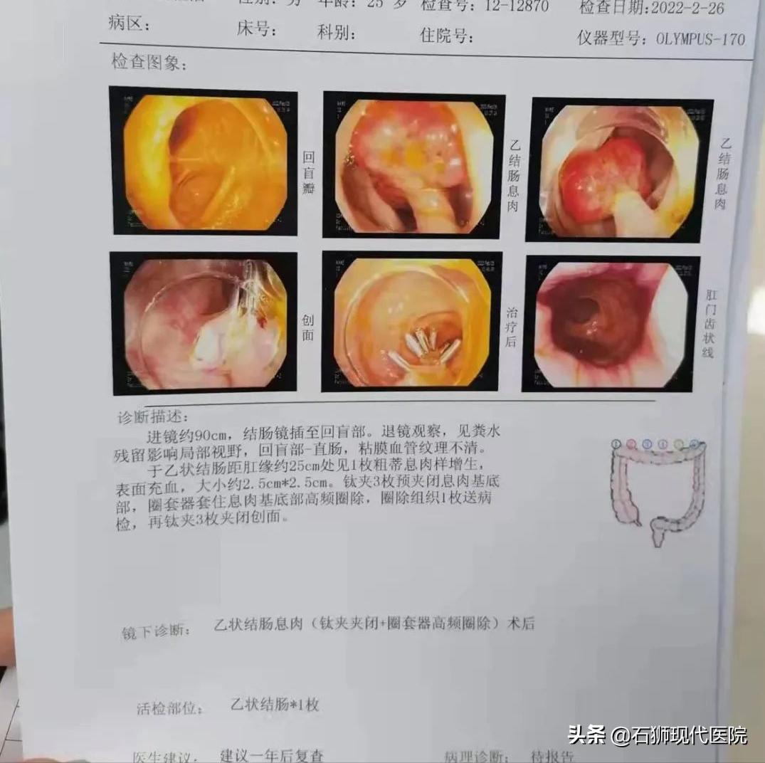 偶尔便血不治疗有什么后果,偶尔便血用去就医吗