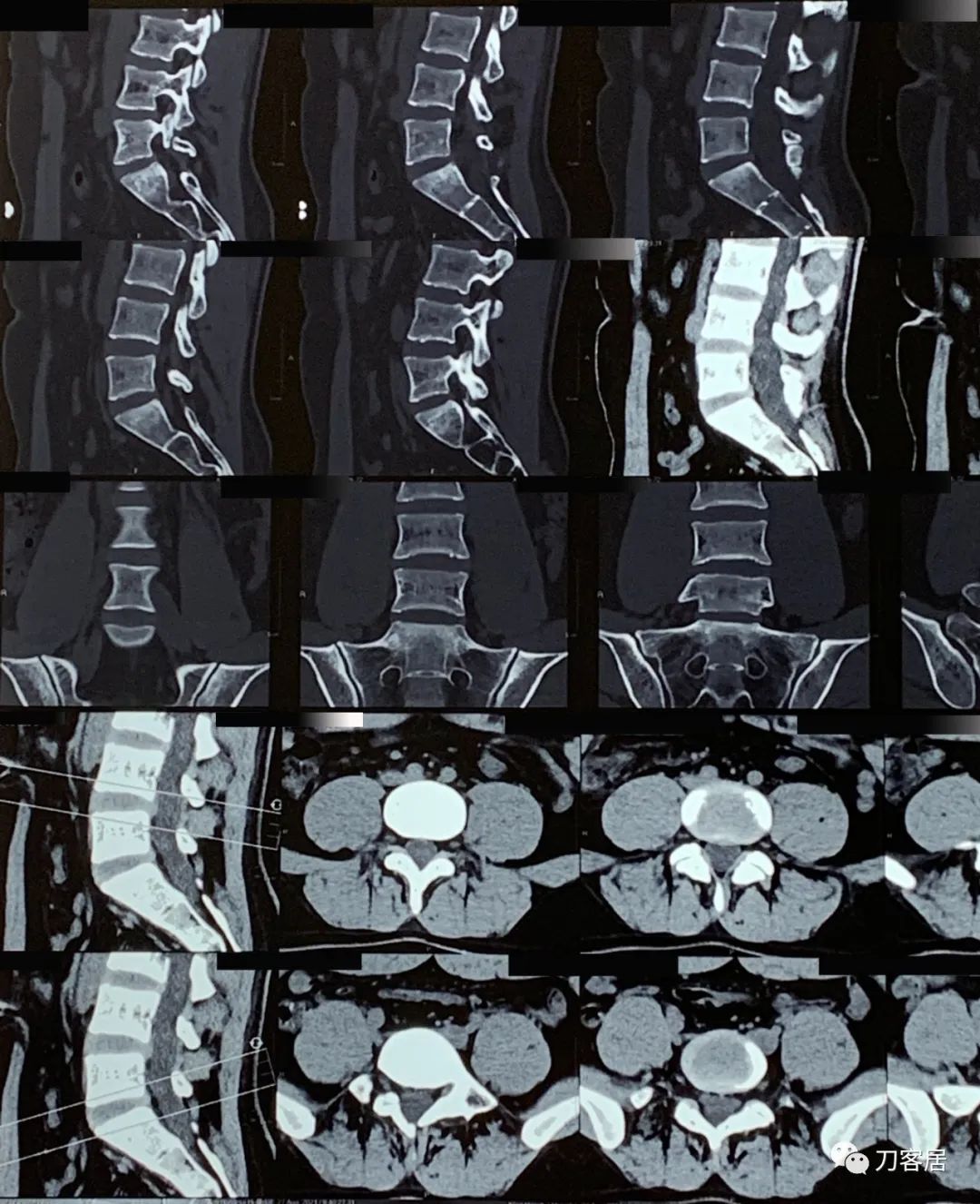 20岁出现峡部裂建议手术吗,20岁腰峡部裂了要不要手术