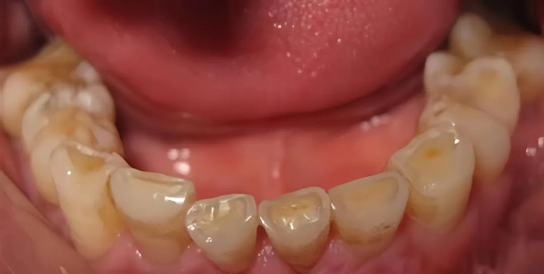 牙齿敏感用什么方法能解决,牙齿敏感快速解决方法