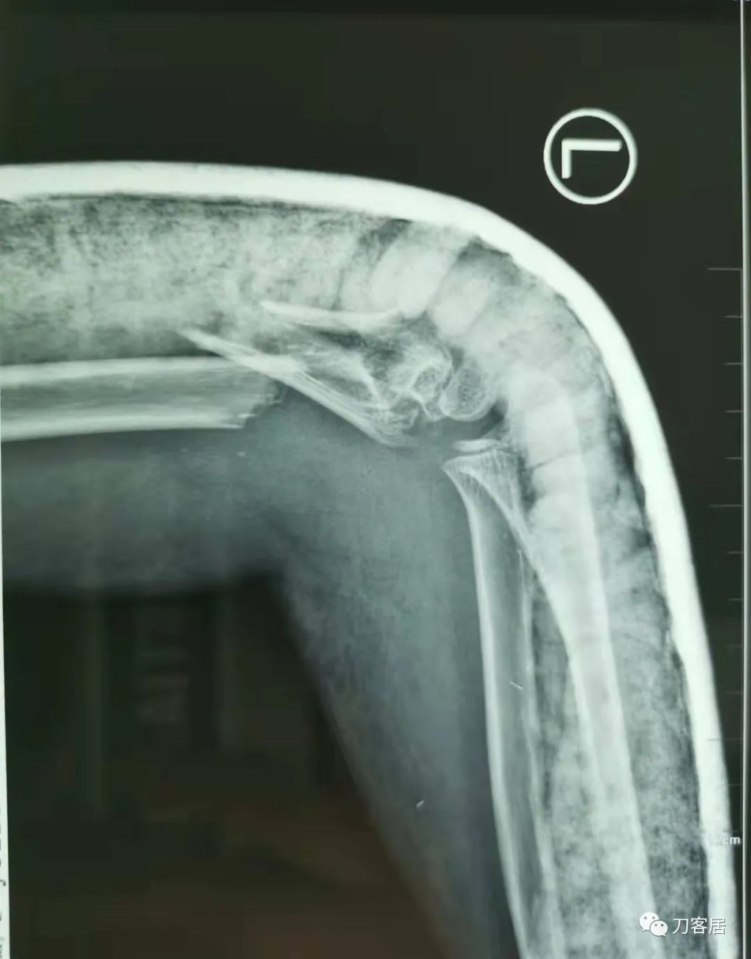 孩子胳膊摔伤肿了不能弯曲一直疼,9岁男孩摔倒手臂痛怎么办