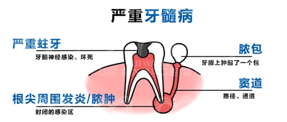 中山大学附属口腔医院牙缝修复,苏州华夏口腔修复牙缝
