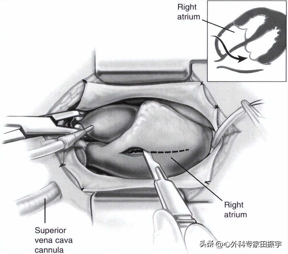 二尖瓣成形术,二尖瓣成形术后需要静养多久