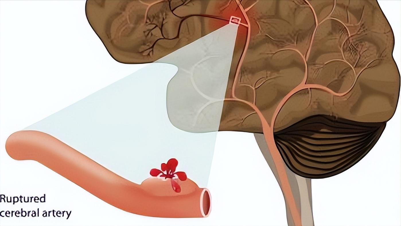 高血压引起脑出血最佳抢救时间,家里老人有点脑出血一般怎么治