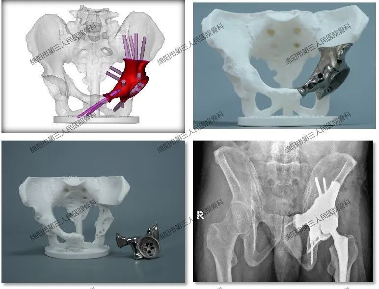 3d打印下颌骨植入手术,3d打印治疗骨肿瘤