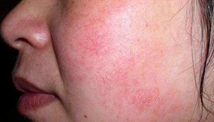 脸部皮肤又红又痒，是过敏了吗？正确的护理方法要牢记