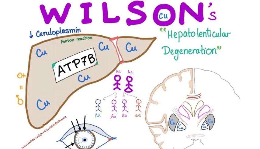 什么叫肝豆状核变性患者,肝豆状核变性可治的遗传病