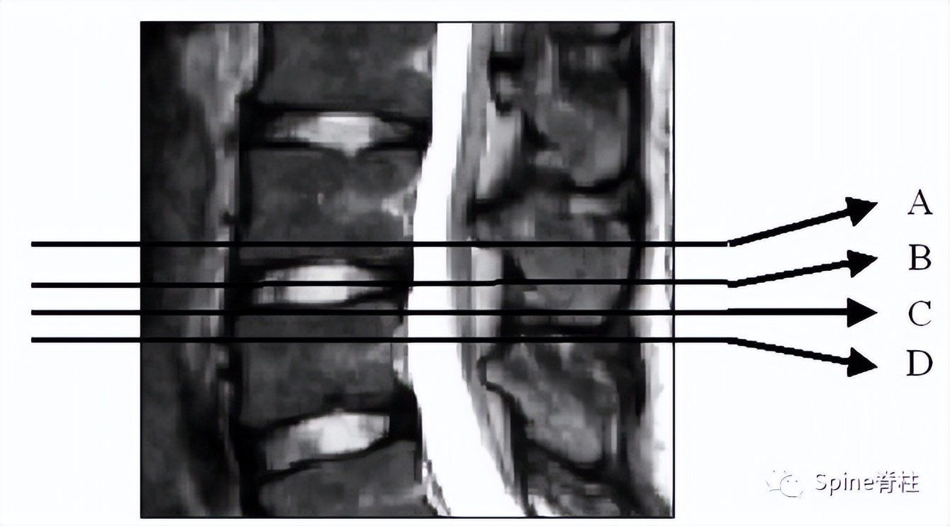 轻度峡部裂和重度峡部裂的区别,真性峡部裂和假性峡部裂