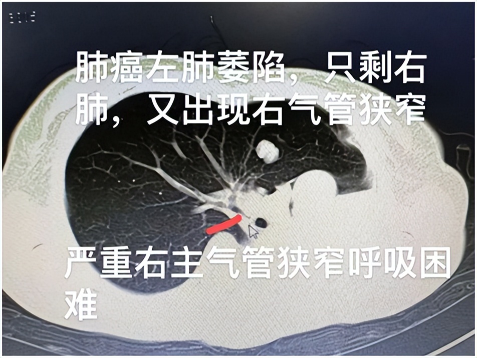 介入粒子植入和肿瘤消融术,微创可视细胞支架植入术