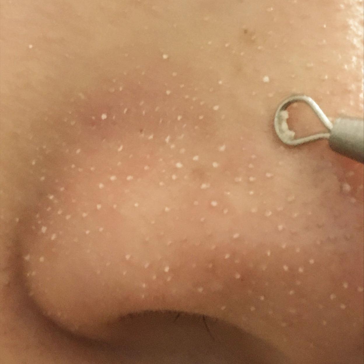 鼻子毛孔小黑头出不来怎么办,小女孩鼻子有黑头毛孔粗怎么办