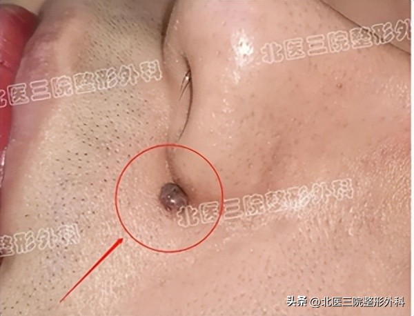 鼻翼切痣容易留疤么,鼻翼旁的痣怎么切除