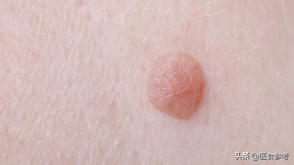 皮肤上小疙瘩抠掉就出血,皮肤上的小凸起可以自己去掉吗
