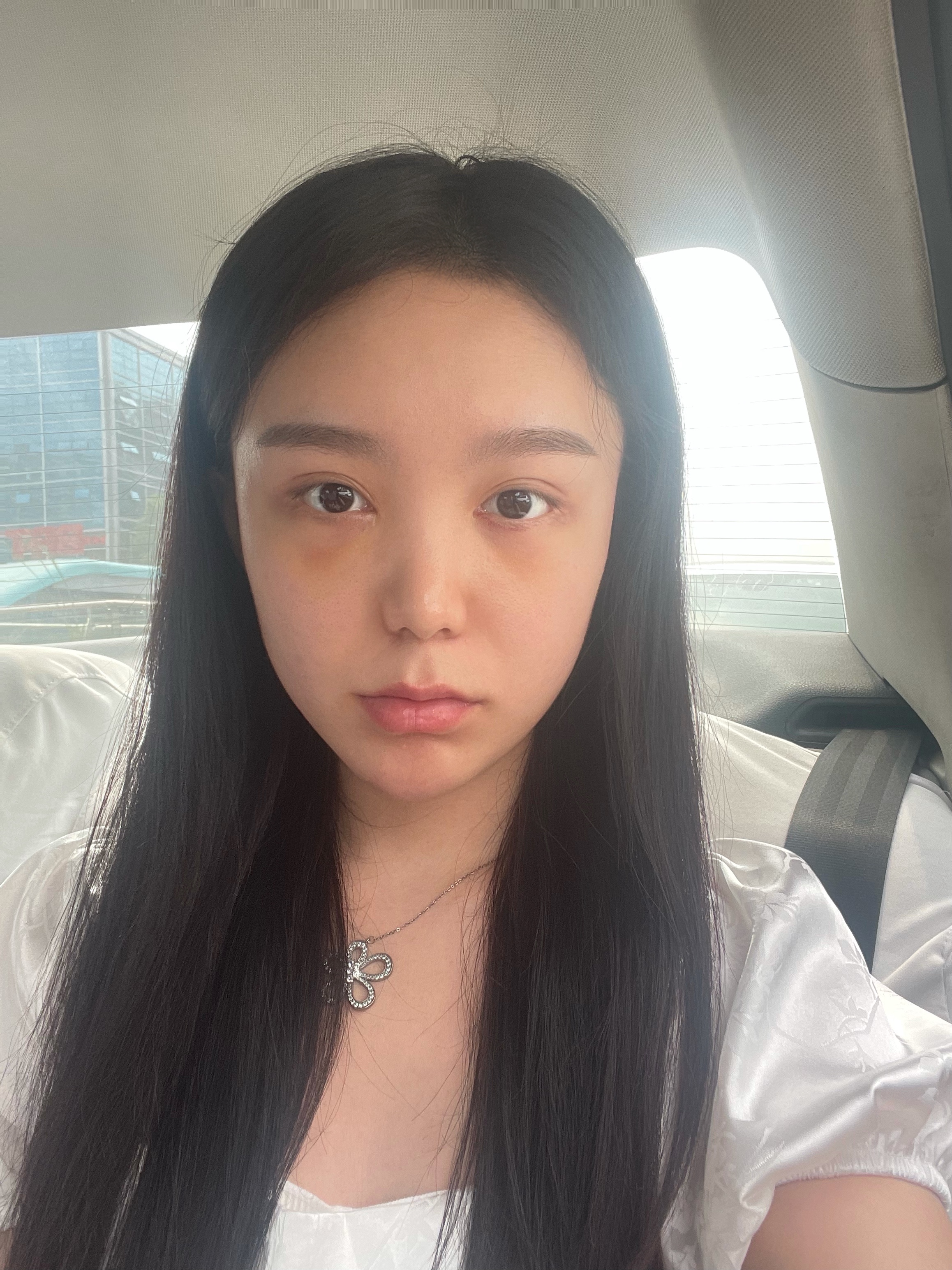 上海第九人民医院不开刀去除眼袋,顽固眼袋别担心不开刀也能变好看