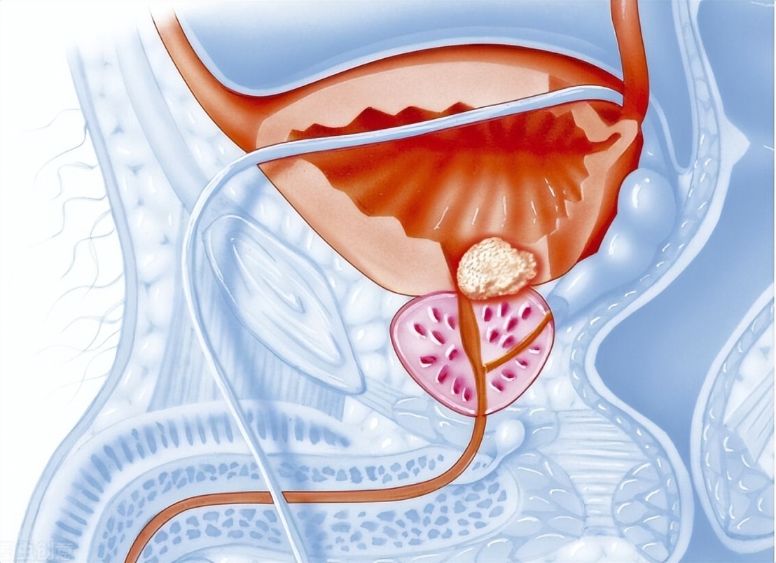 尿路感染最常见的致病菌有哪些,发生尿路感染最常见的感染途径是