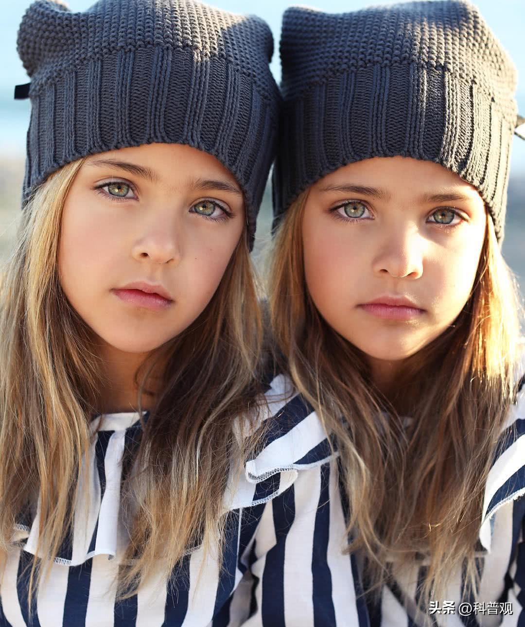 连体人一方死亡怎么办？妹妹去世后，连体姐姐被迫跟遗骸共同生活