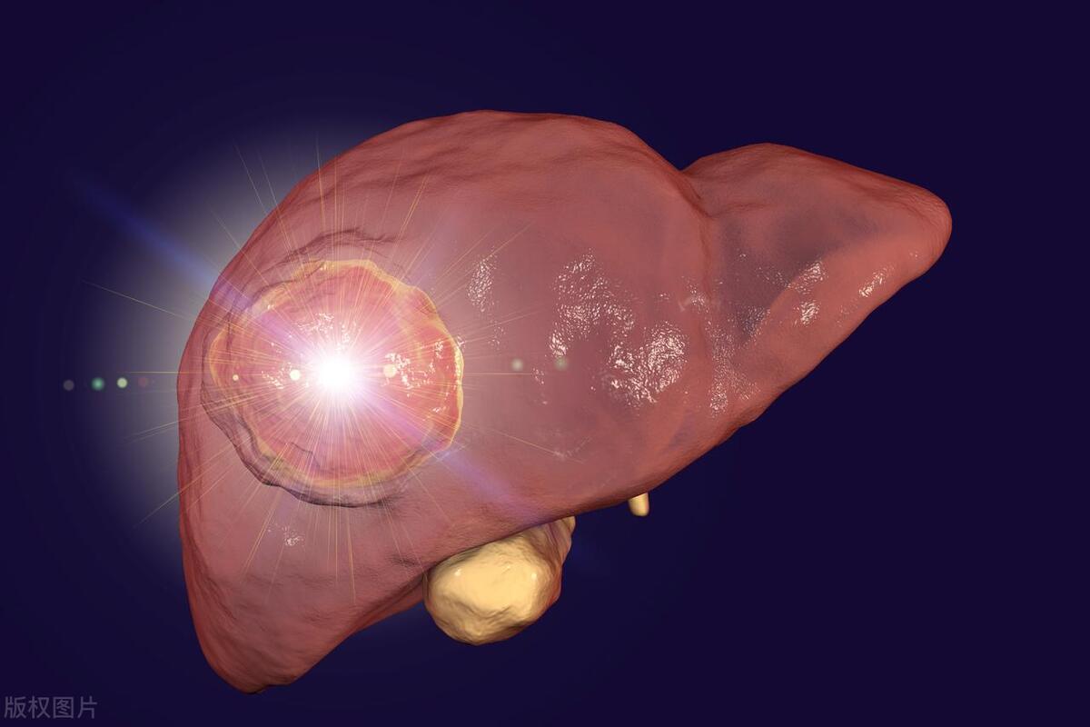 肝癌晚期经过治疗还能活多久,肝癌一般要多久才能变成肝癌晚期