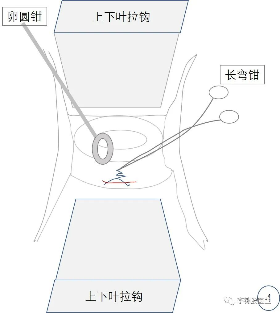 宫颈环扎术的详细步骤,宫颈环扎线拆除多少钱