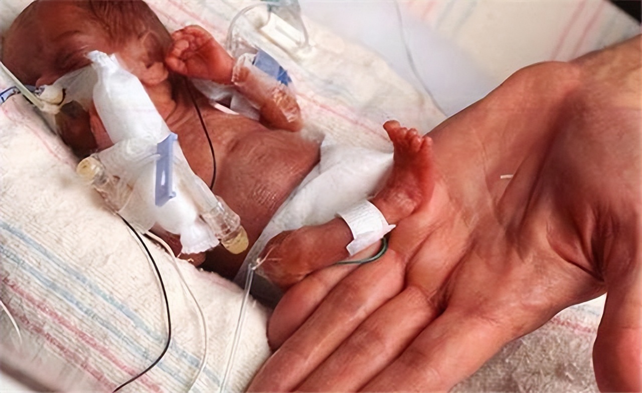 美国真实版拇指姑娘,拇指姑娘出生时图片