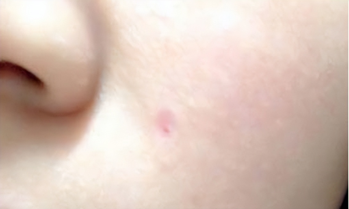 什么药水点痣不留疤痕,网上那些点痣药水真的假的