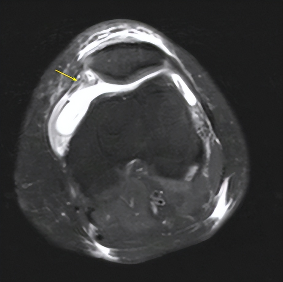 打羽毛球怎么防止肌腱断裂,打羽毛球韧带断裂