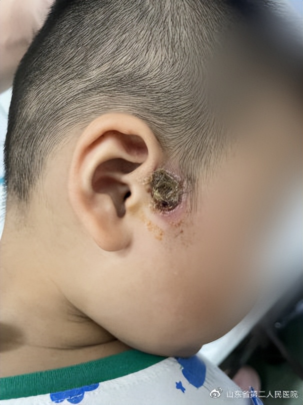 3岁孩子耳前瘘管可以开刀吗,三岁孩子耳前瘘管没发炎能手术吗