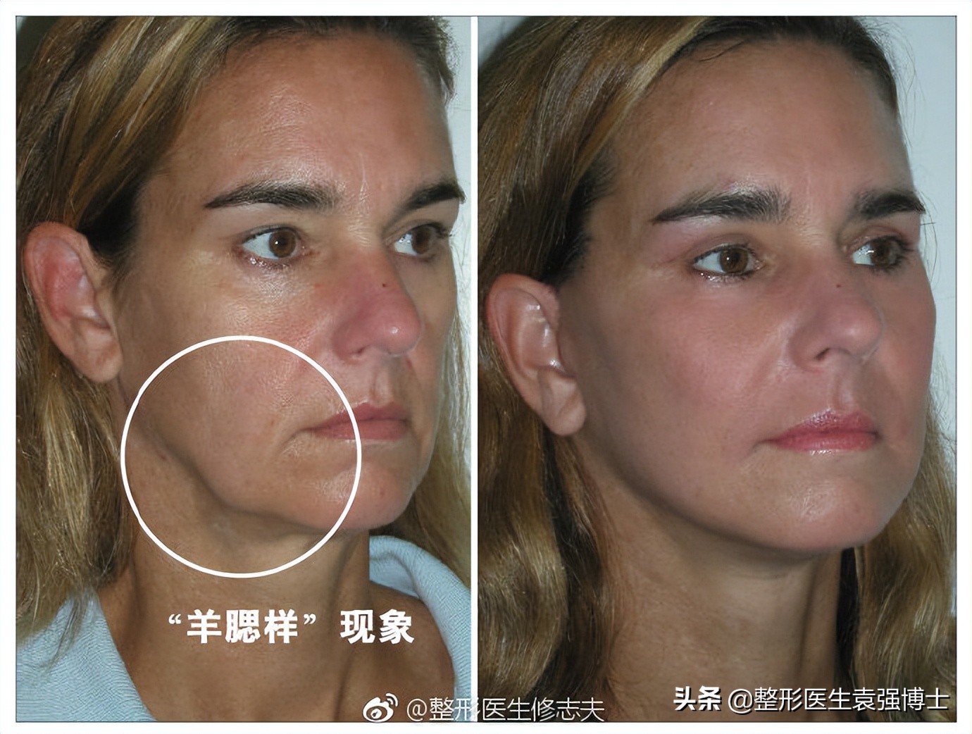 45岁脸垮有什么办法,四十岁怎样防止脸部发腮