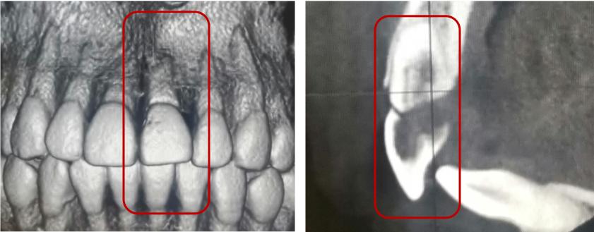 牙齿受外伤吃什么对牙好,牙齿受损伤引起牙痛怎么办
