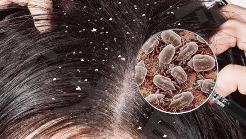 头皮总是长疙瘩或脓包是什么原因,头皮起脓包疙瘩是怎么回事