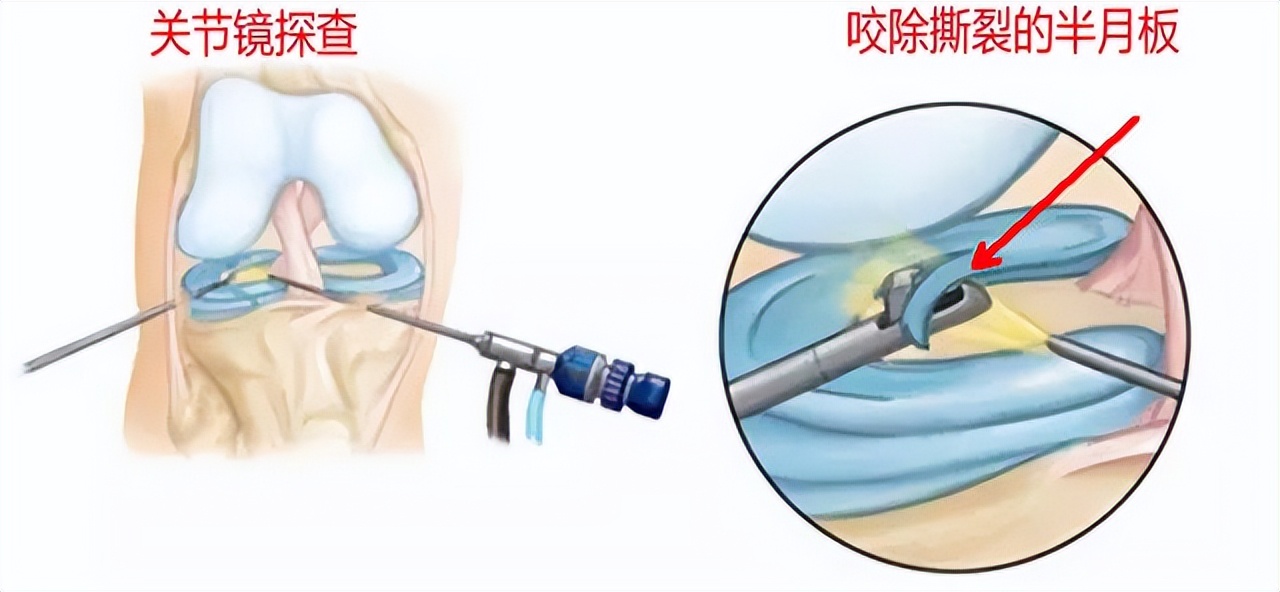 半月板损伤严重的状态是什么,半月板损伤应该注意什么问题