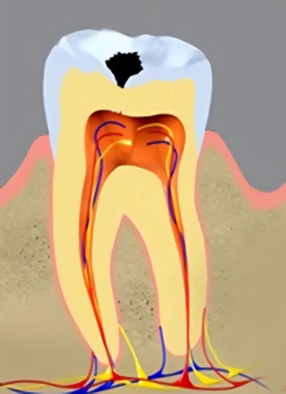 牙痛的最快止痛方法没有药吃,牙痛除了吃止痛药还有什么方法