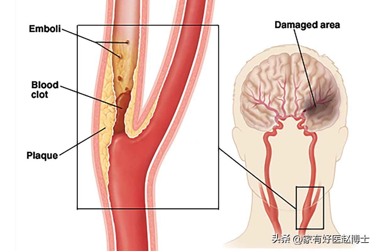 胆固醇正常以后他汀还要吃吗,胆固醇高吃他汀要一直吃吗