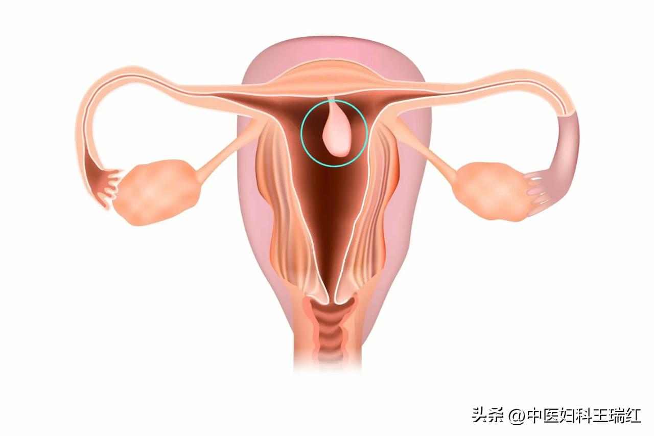 发现子宫息肉必须做手术吗,宫腔镜子宫内膜息肉电切术