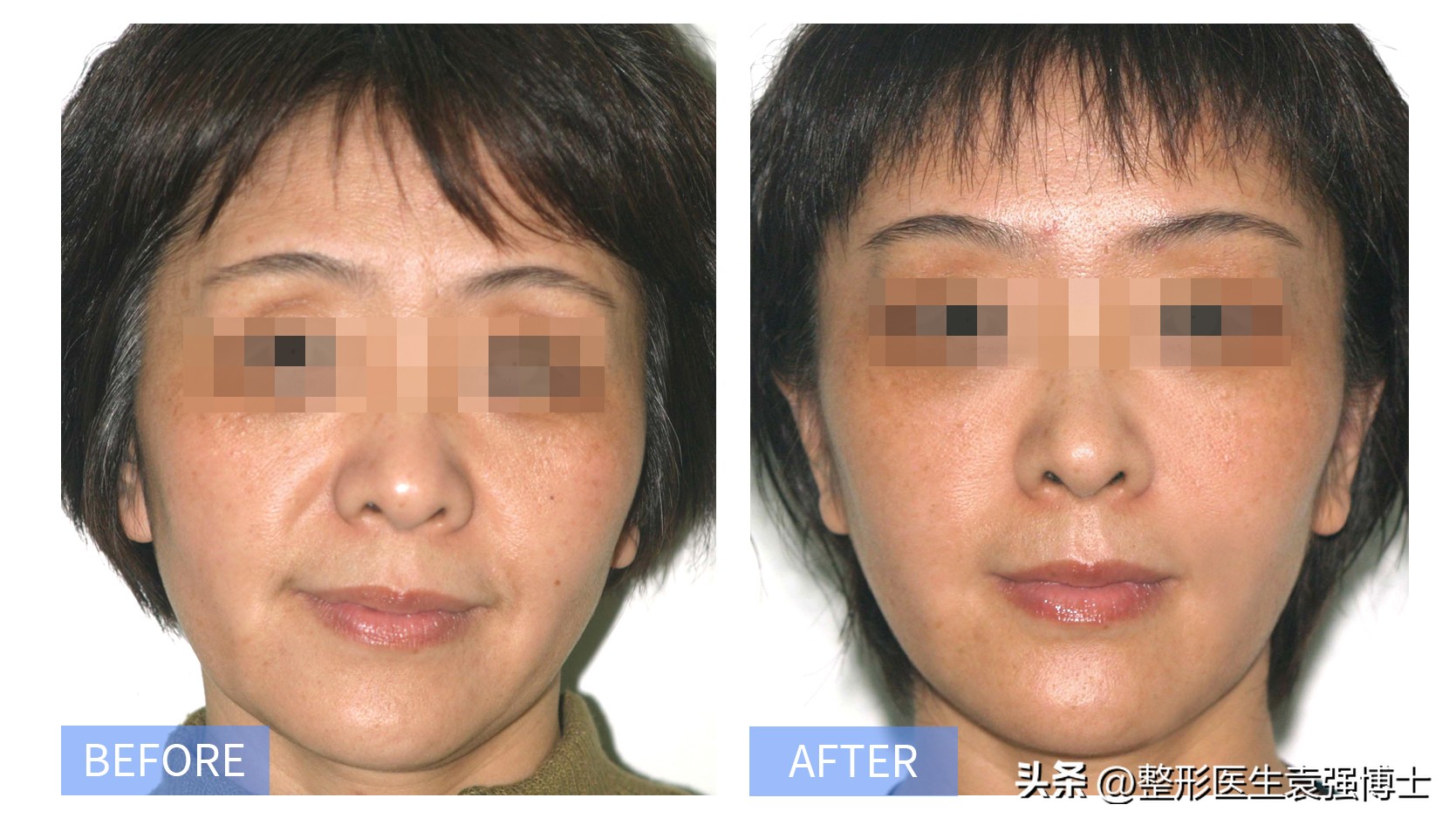 35岁做拉皮能挺几年,三十多岁做拉皮能维持多久