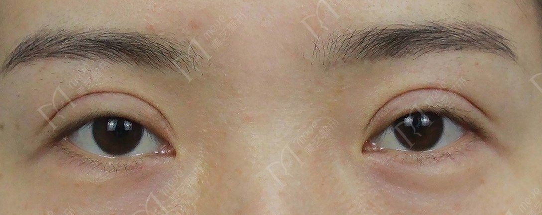 平行双眼皮和开扇形哪个更好看,平行双眼皮变成扇形双眼皮
