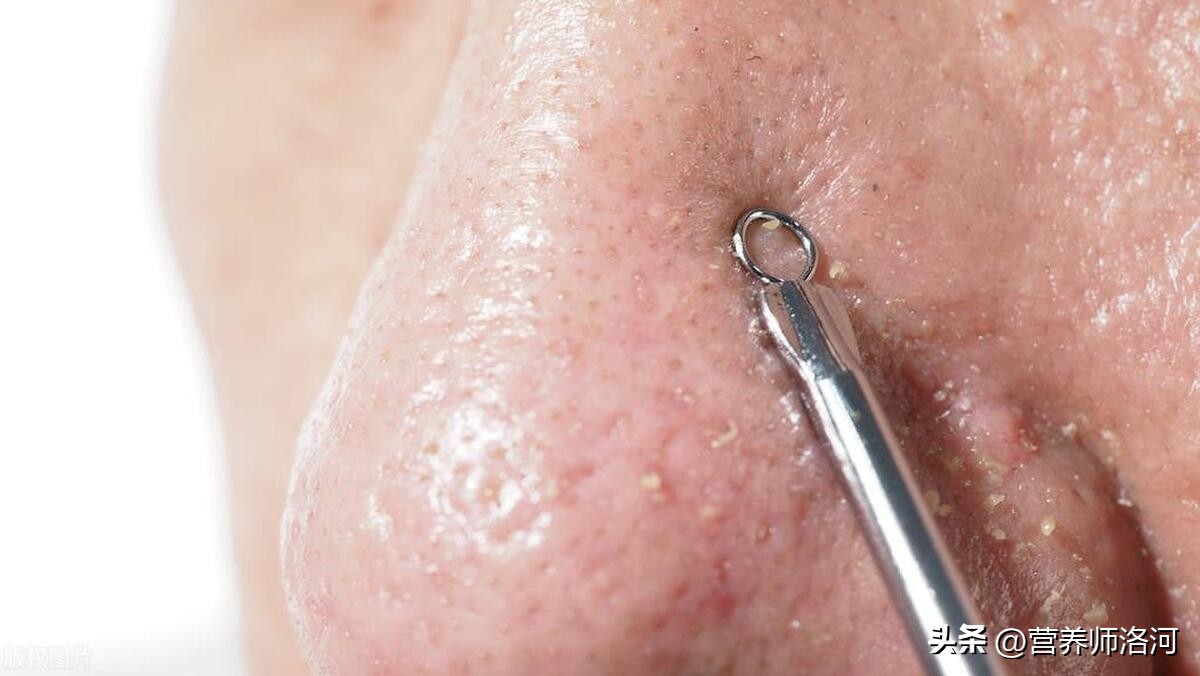 鼻头有黑头如何祛除小窍门,鼻头黑头可以喝什么来改善
