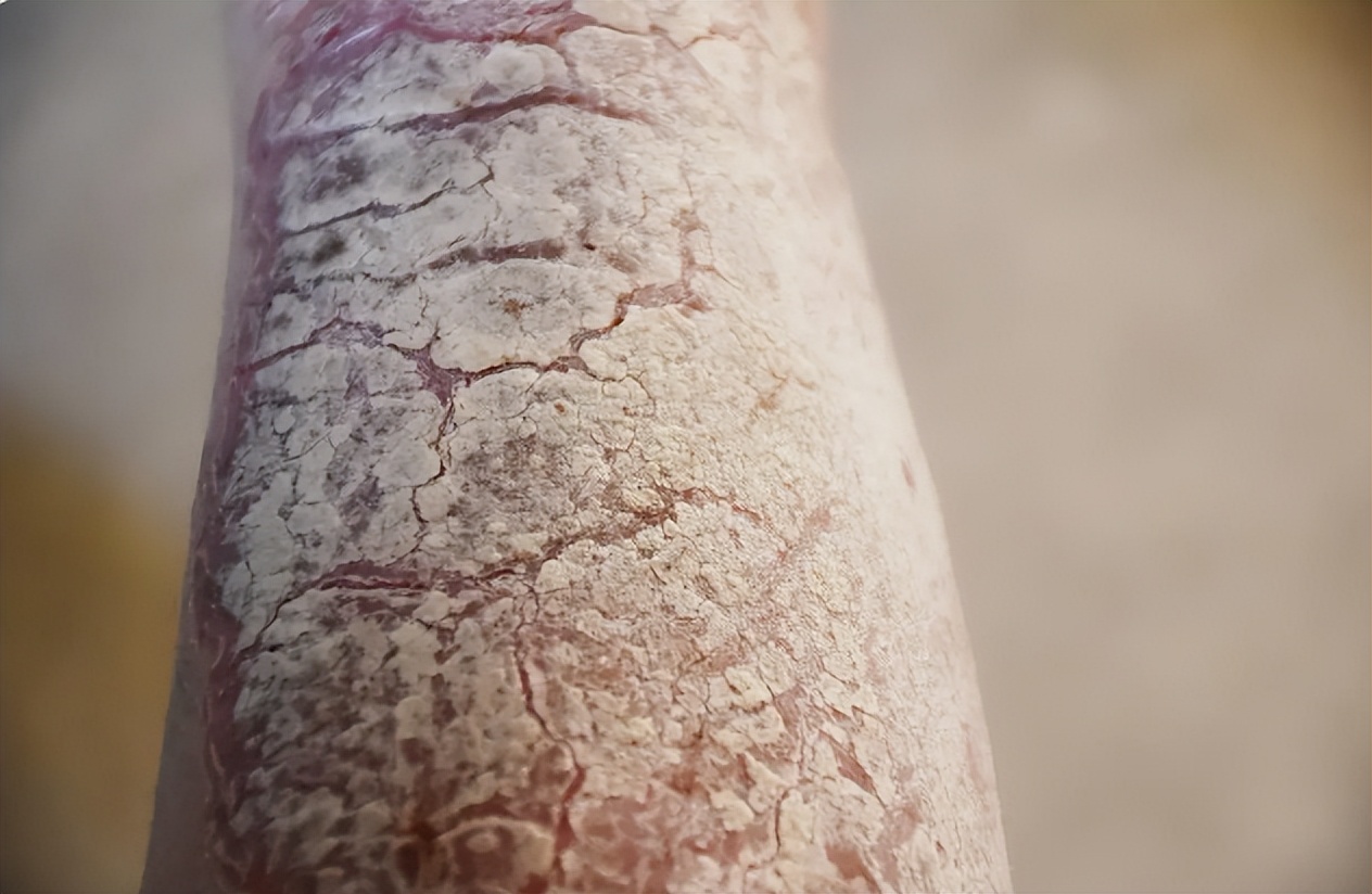 治疗银屑病头癣用什么软膏比较好,牛皮癣头癣用什么中药方子