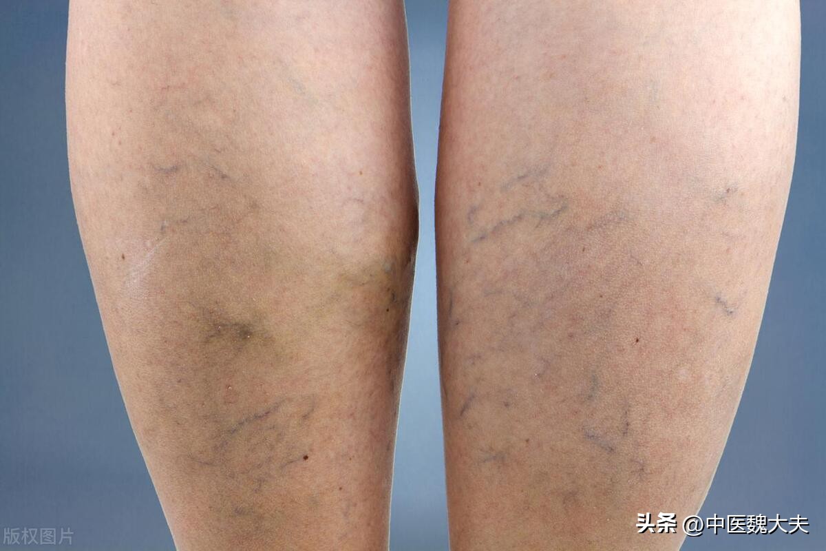 为什么有的人手臂不会爆青筋,手臂青筋颜色明显但不凸出