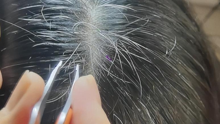 为啥白头发越长越多？你以为是老了，医生：或是缺乏这几种营养素