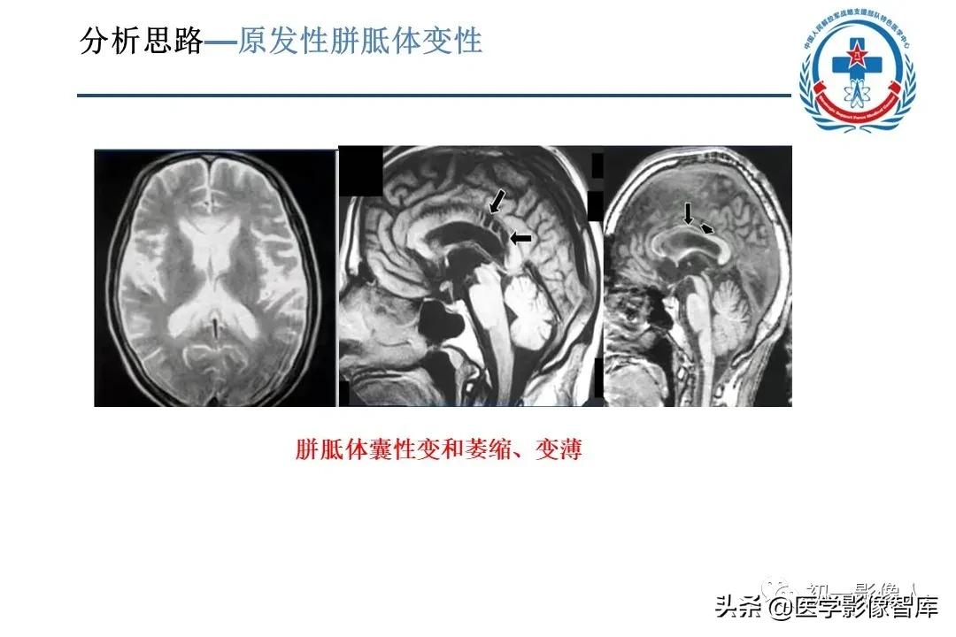 胼胝体变性治疗方法,原发性胼胝体病变治疗