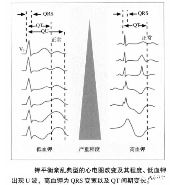 血钾危急,高钾血症危急值记录