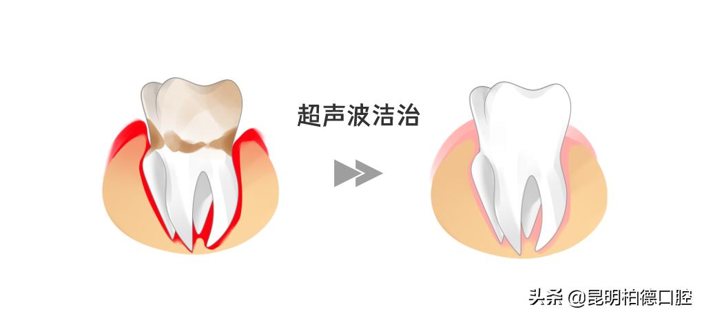 洗牙里面喷砂和抛光有什么区别,洗牙抛光和喷砂抛光的区别