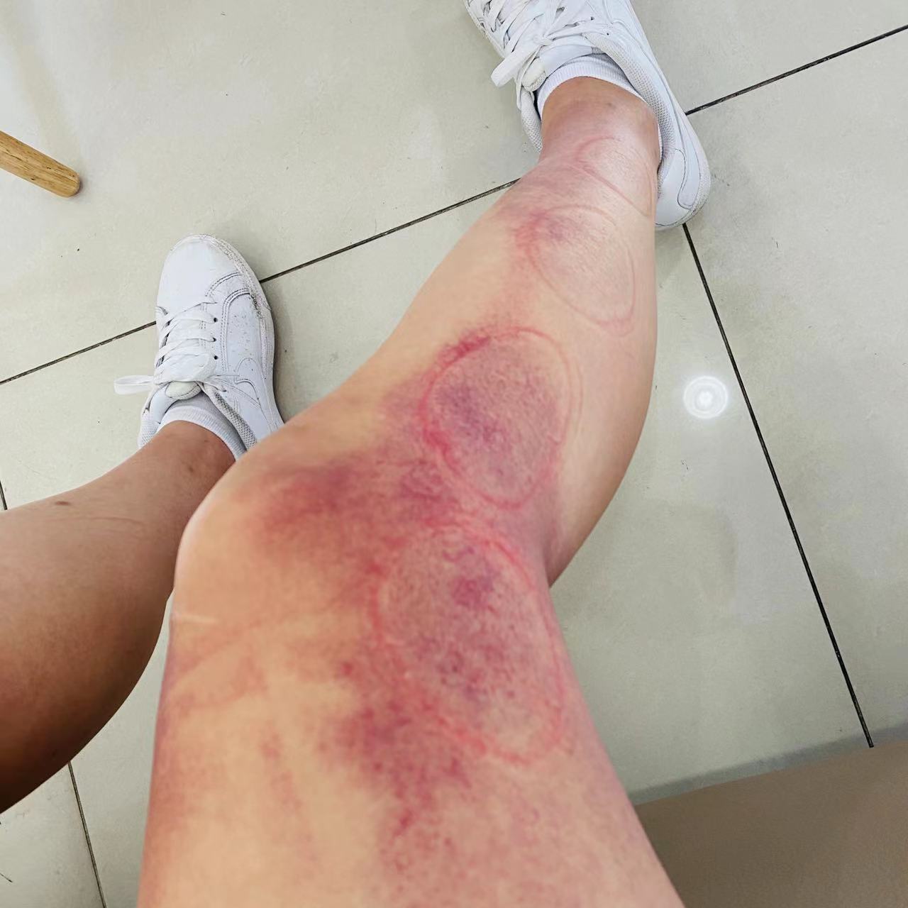 留学生亲历韩国*踏事踩**故：被压1小时才被救出，看到有父亲将四五岁孩子拼命递出人群，将是此生难忘噩梦