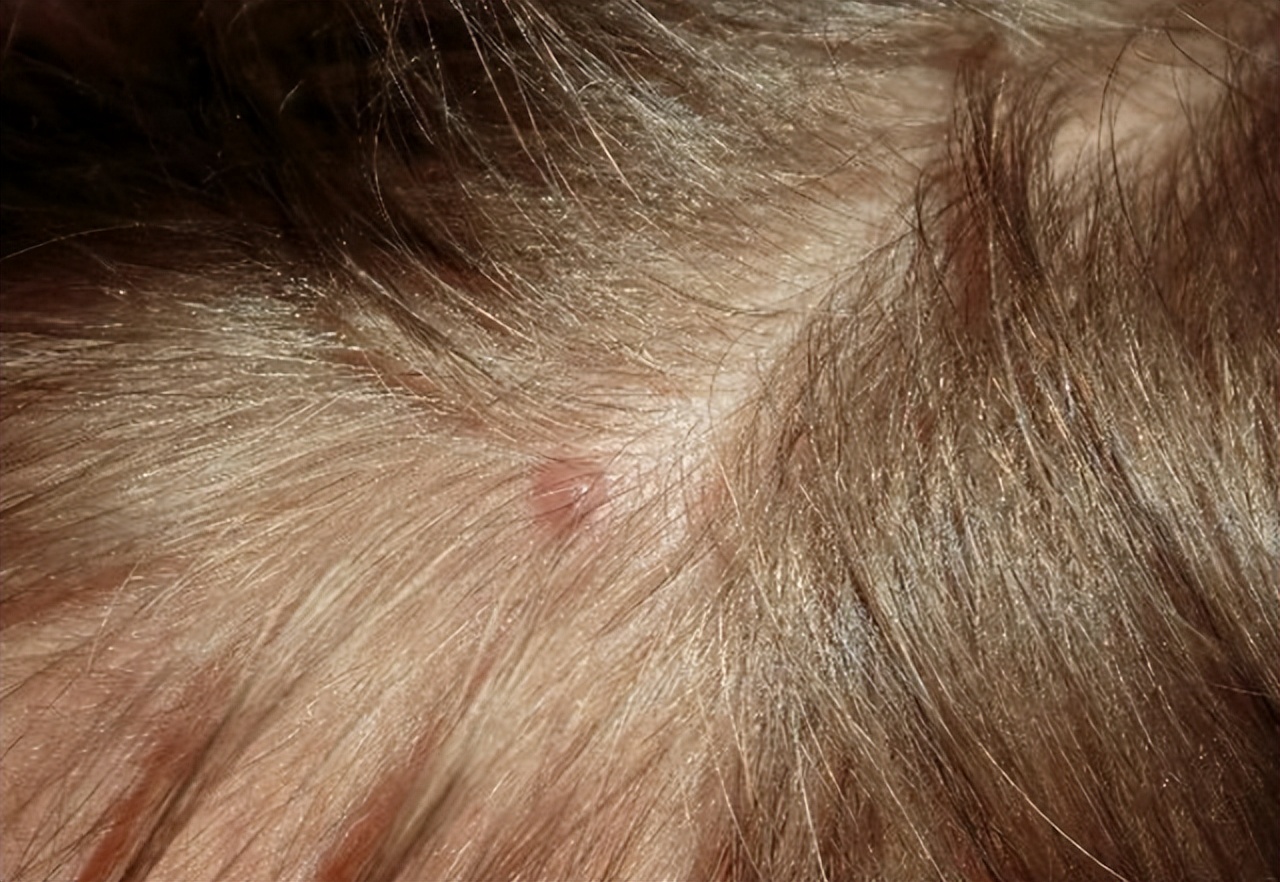 为啥头皮总长“脓包”和“疙瘩”？提示：或与这4点有关