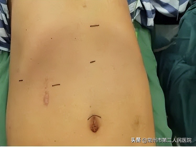 严重心脏病遇上肝肿瘤常州二院成功实施荧光腹腔镜下精准切除