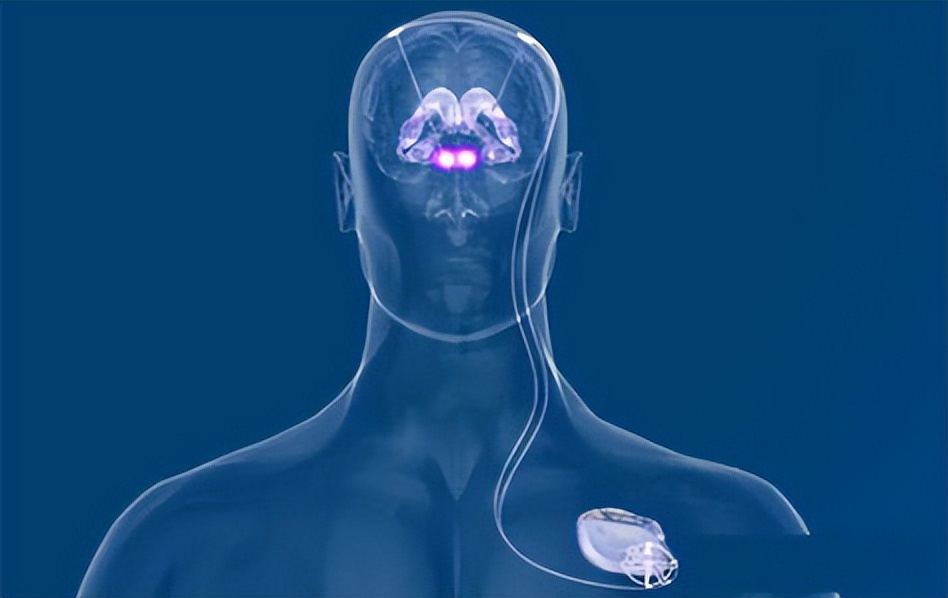 dbs治疗痉挛性斜颈优势,dbs帕金森安全吗