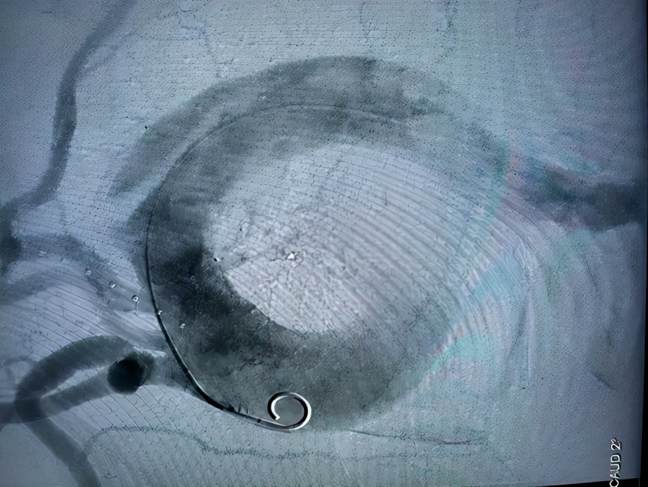 大脑中动脉动脉瘤介入栓塞手术,大脑前动脉夹层手术