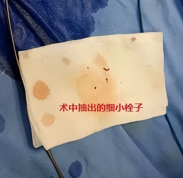 小血栓轻微堵塞血管,左上肢肱动脉血栓取栓手术