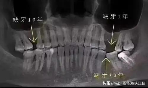 小孩牙齿边缘有黑线要怎么补救,牙齿长黑的东西怎么处理