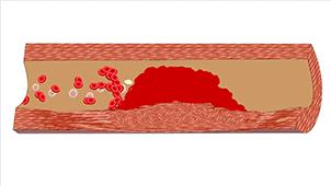 图解血管堵塞全过程，三氧疗法保持血管“年轻态”！