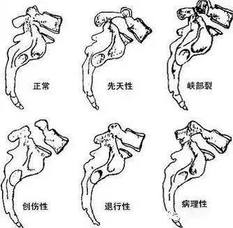 腰椎滑脱的病因,腰椎滑脱症最常见的鉴别诊断